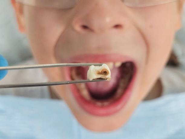 Best Chipped Tooth Repair Near Me  in Halesite, NY